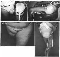 Hip Disarticulation Techniques Image
